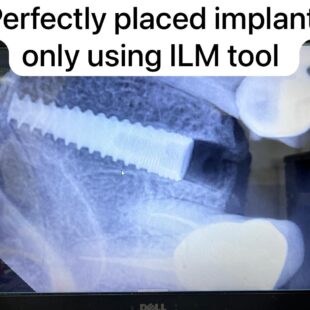 Julldent 169 Pterygoid Path Finder ILM Tool - Image 8