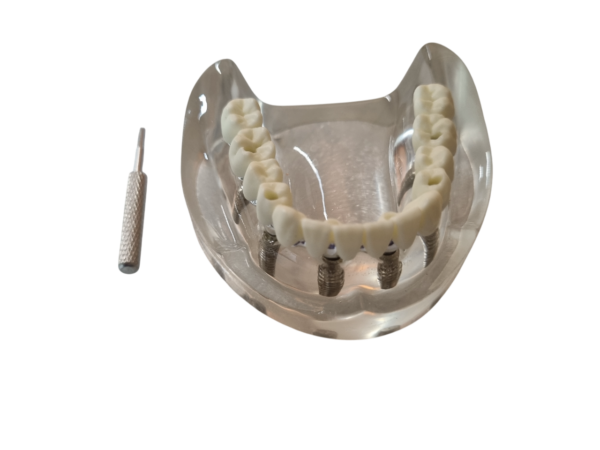 Julldent 181 All on 4 Paulo Malo Model with Prosthesis