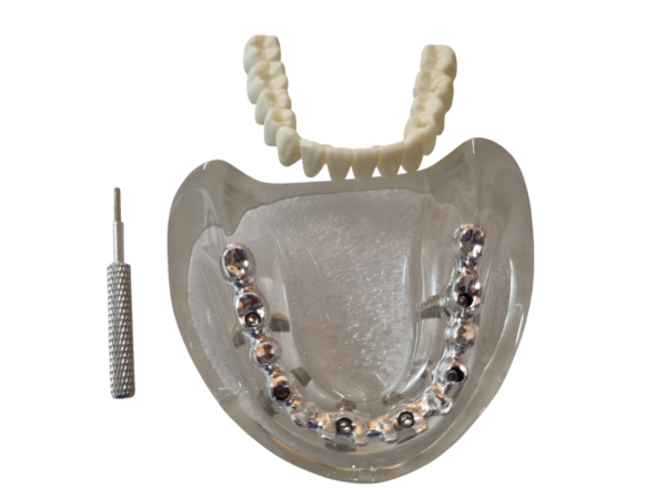 Julldent 181 All on 4 Paulo Malo Model with Prosthesis - Image 2