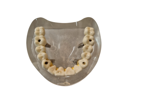 Julldent 181 All on 4 Paulo Malo Model with Prosthesis - Image 3