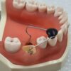 070 Freehand Flap Retractor - Image 2