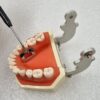 Julldent 184 Gingival Tunnelling Template - Image 2