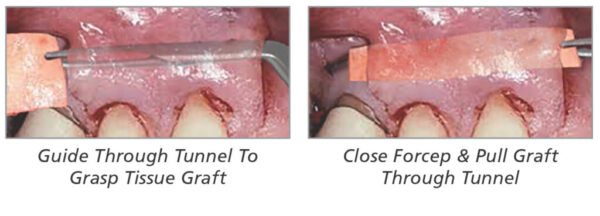 Julldent 187 Tunnelling Forcep - Image 3